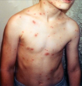Child_with_chickenpox